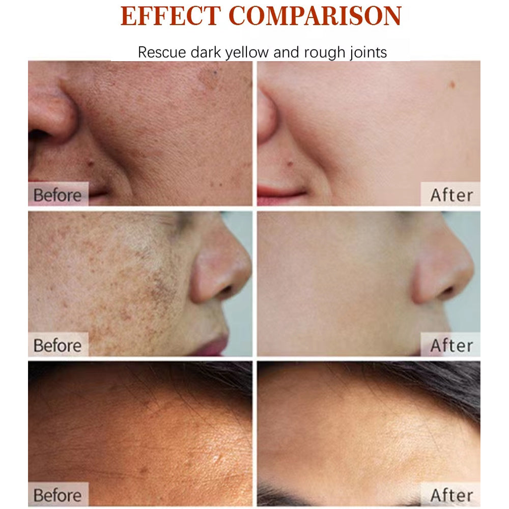 Natural Vegan Neck Facial Vitamin C Acne Pimples Dark Spot Remover